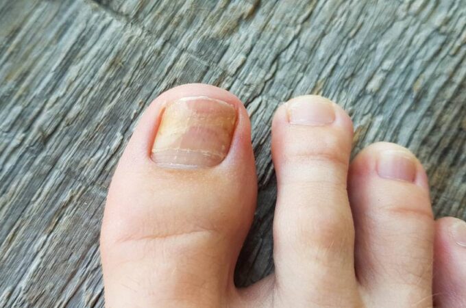 Living with Toenail Fungus: Coping Strategies and Self-Care Tips